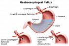 La modulazione dei carboidrati nella gestione del reflusso gastroesofageo